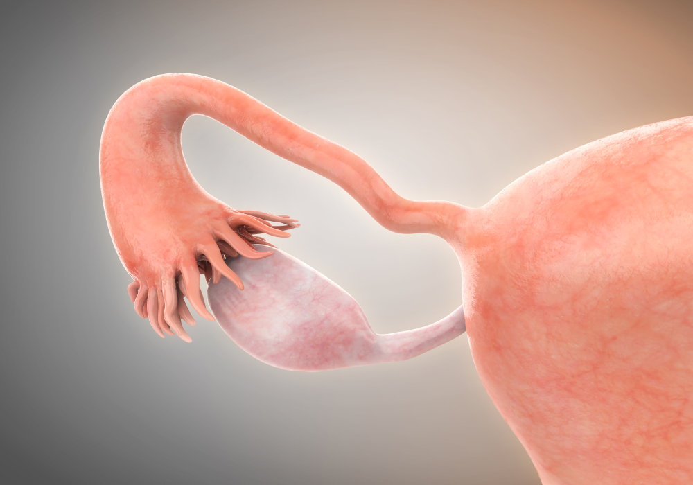 ¿Qué es el cáncer de ovario?